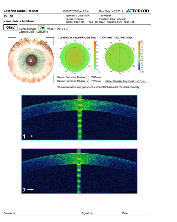 Tomografie oculara Zalau