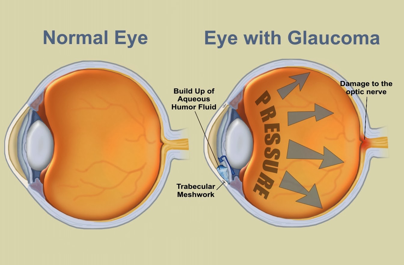 boala de ochi glaucom