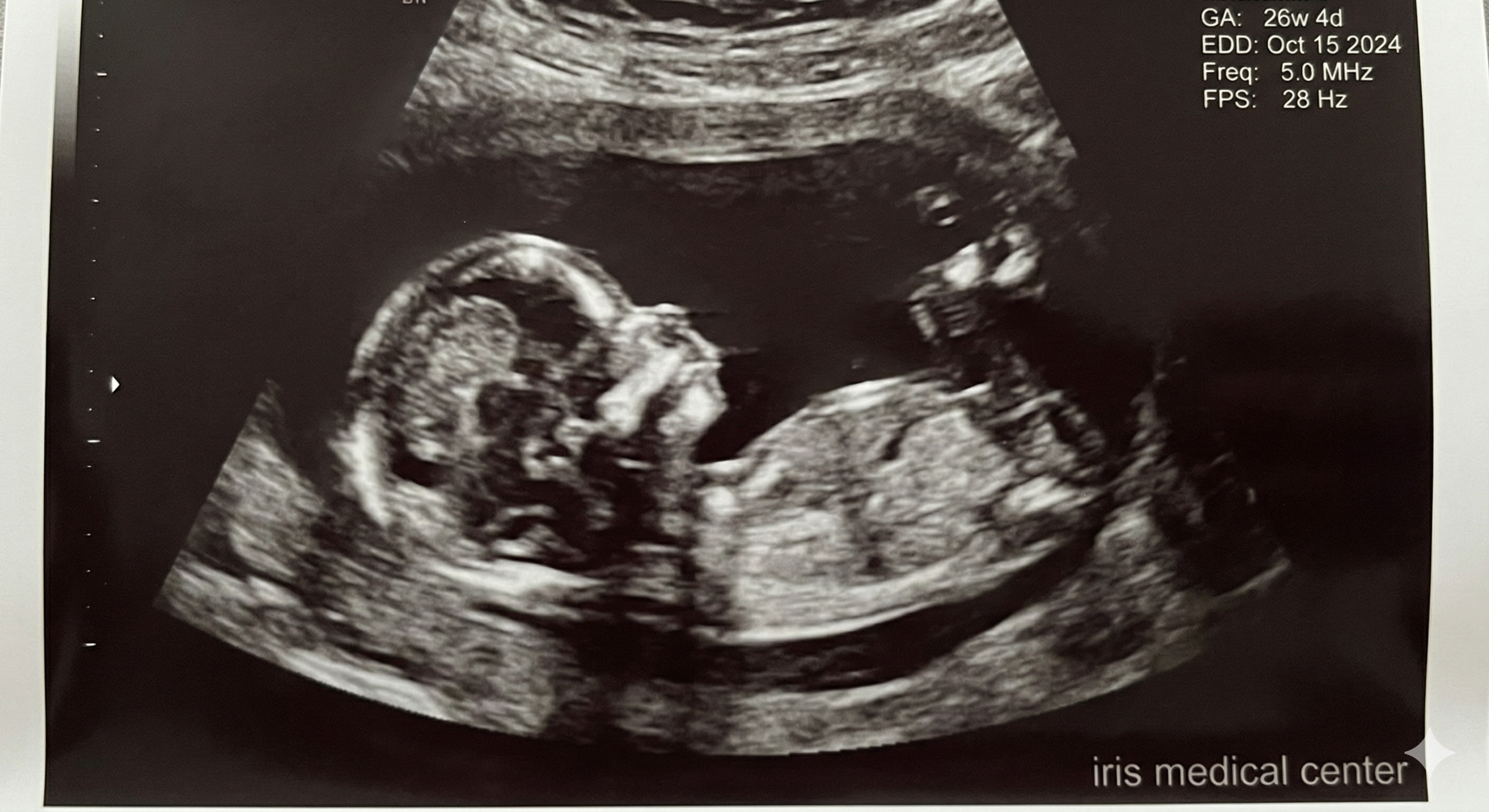 Detailed 4D obstetric ultrasound scan showing fetal development at Iris Medical Center