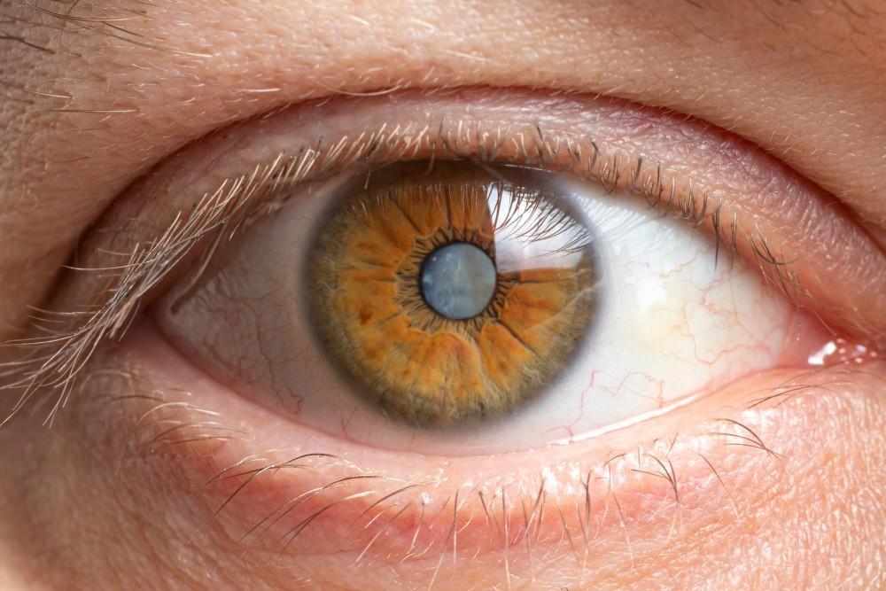 Illustration of a human eye with a clouded lens indicating advanced cataract development