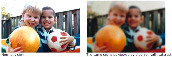 Comparison view showing blurred vision caused by cataract versus healthy clear vision