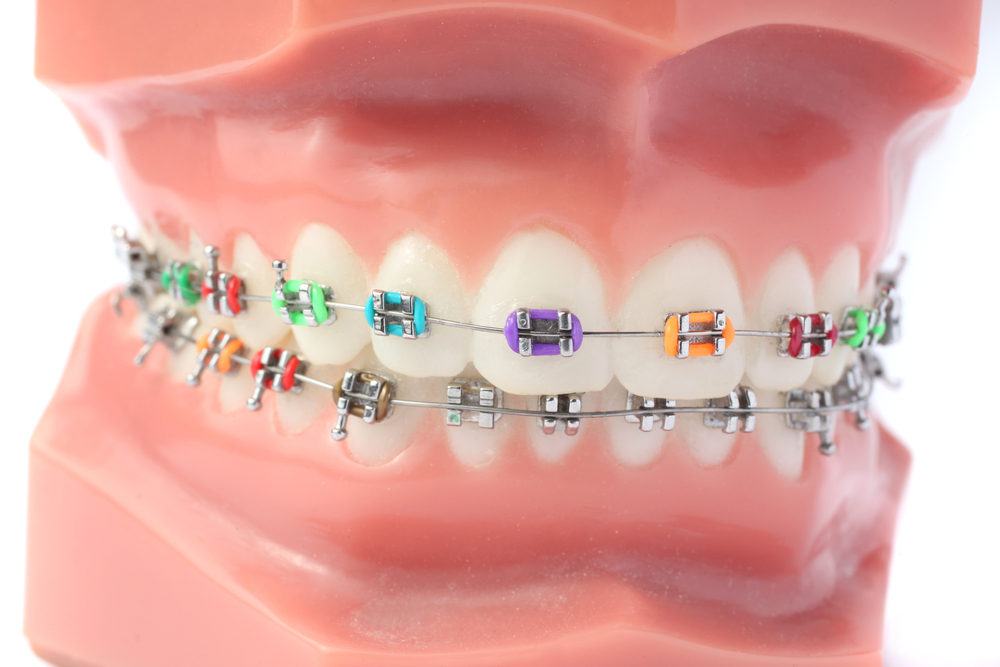 Display of various orthodontic appliances including fixed metal braces and removable functional devices